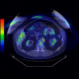 PET/CT image for a patient with cancer